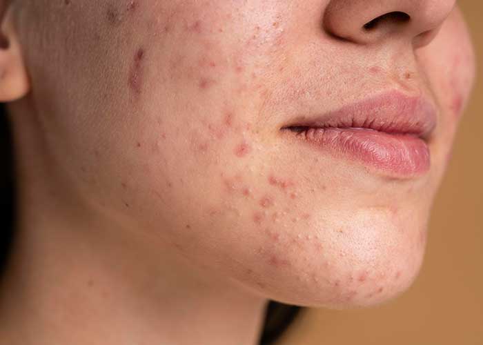 Qual o melhor tratamento para cicatriz de acne?